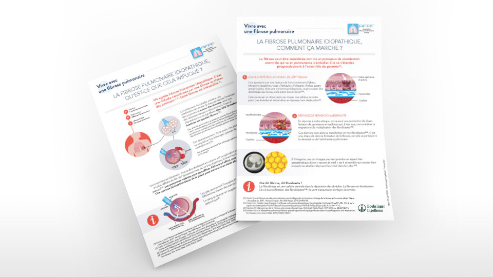 La fibrose, qu'est-ce que cela implique ? La fibrose, comment ça marche ?